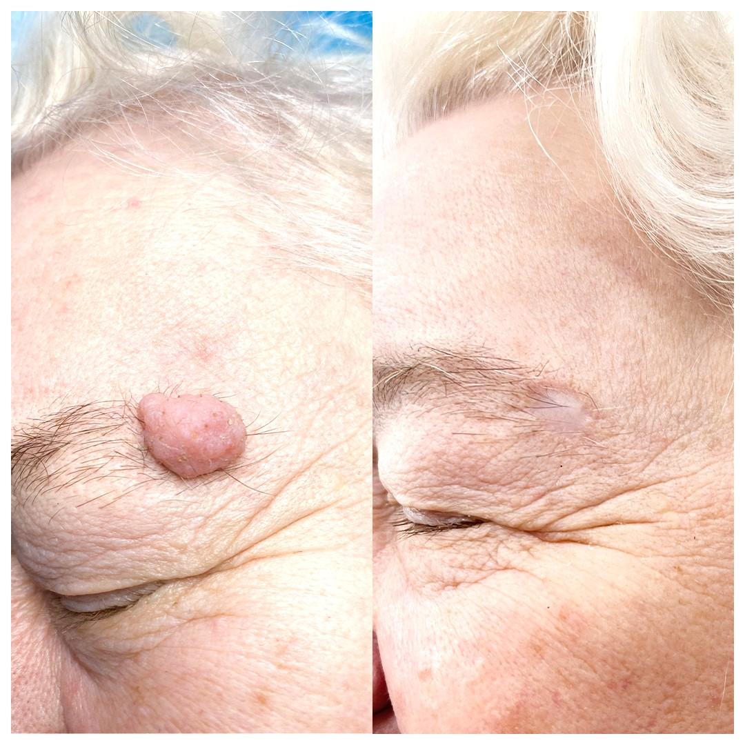 видалення родимки лазером - Київ